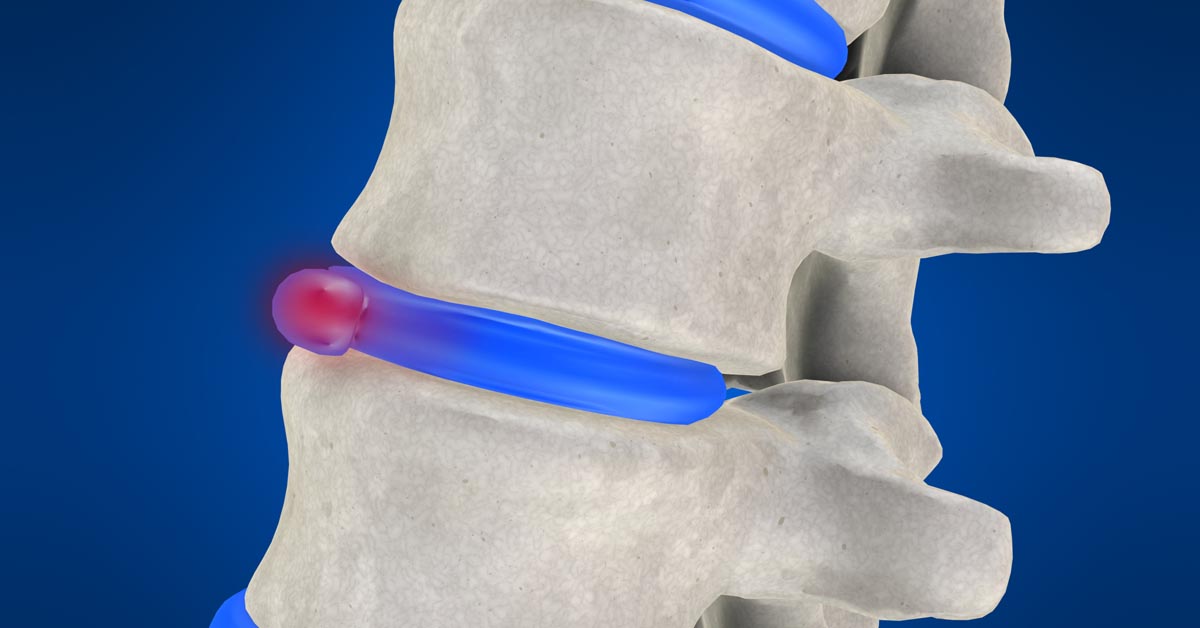 Moon Township non-surgical disc herniation treatment